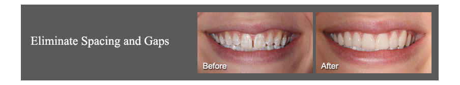 eliminate teeth spacing 